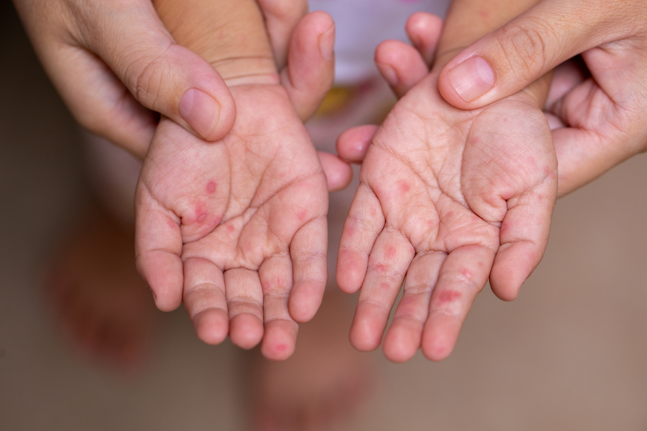 hand-foot-mouth-disease-archives-north-carolina-medical-society